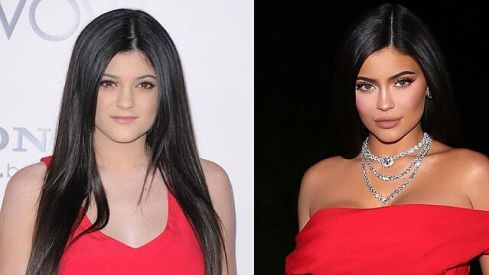 El antes y el después de Kylie Jenner El antes y el después de Kylie Jenner