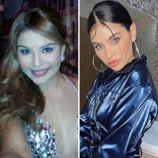 Ninoska Vásquez, antes y después del quirófano